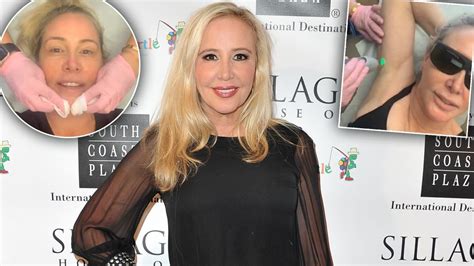 Rhoc Star Shannon Beador Going Overboard With Plastic Surgery