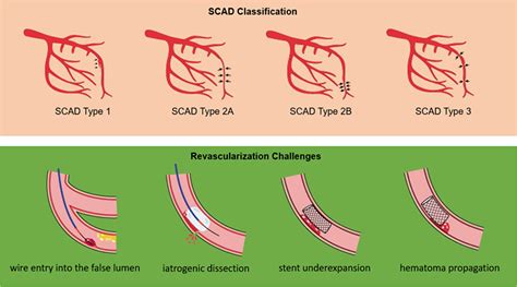 Revascularization In Patients With Spontaneous Coronary Artery