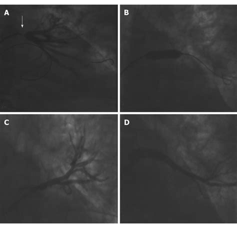 Stent Implantation In A Pulmonary Vein Stenosis A Angiography Showing