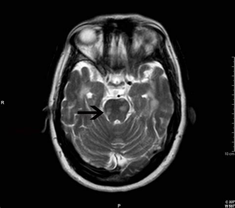 Clinico Radiological Dissociation In Multiple Sclerosis Future