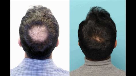 Malik From Leicester Crown Hair Transplant Result With Intro By Dr