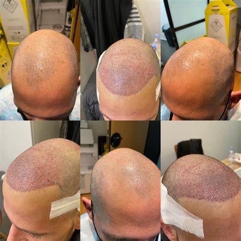 Greffe de cheveux à Paris, découvrez la Maison Marignan