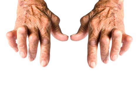 Artrite Reumatoide requer tratamento contínuo Sociedade Mineira de