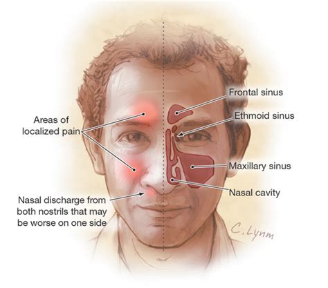 Nasal Cyst Sinus Cyst Types And Methods Of Treatment