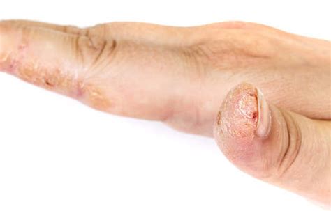 Top 110 Split Skin Thumb Near Nail Architectures Eric