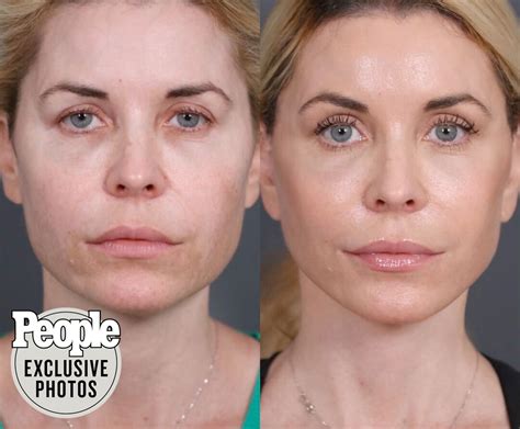 Dr Nassif Facelift Transformation Following Patients Painful Journey With Fillers Nassif