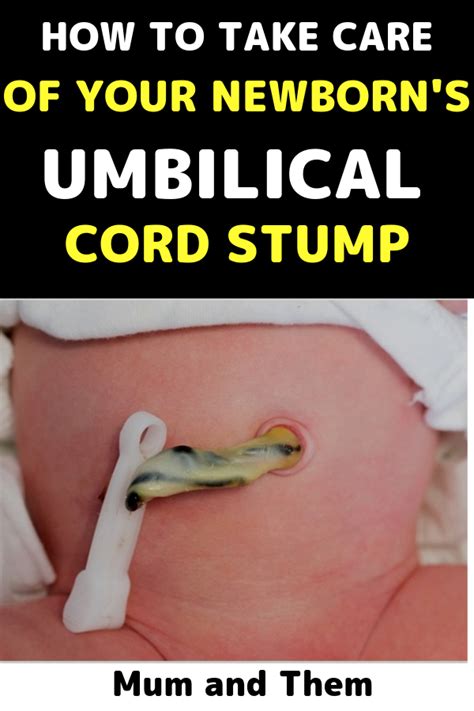 How To Take Care Of Newborns Umbilical Cord Stump Taking Care Of