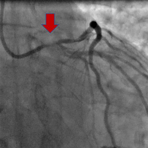 Coronary Angioplasty Or Stenting Central Heart