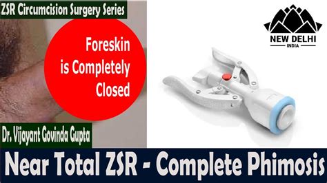 Total Circumcision In Complete Phimosis Zsr Circumcision Surgery Video 2 Youtube