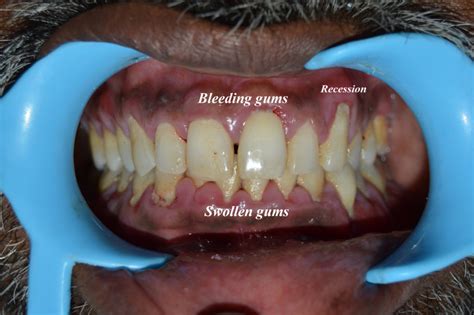 Early Signs Of Gum Disease Dt Smile Care