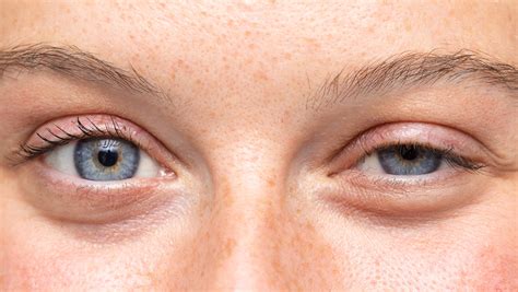 The Best Way To Treat An Inflamed Eyelid