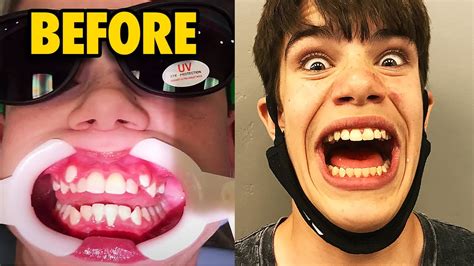 A bracket is a thick black line, the width of a beam, that groups staves together, most commonly according to instrument family. Getting My Braces Off... YES it HURT! - YouTube