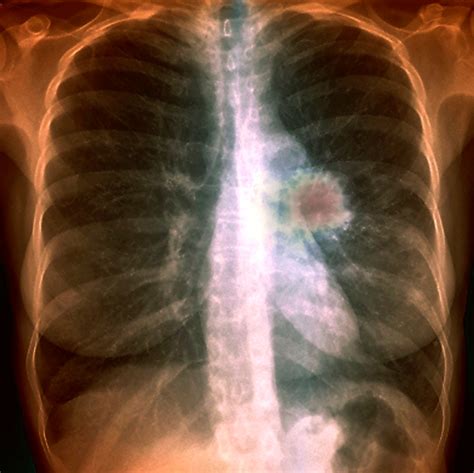 Lung Cancer Postoperative Complications Reduced With Preoperative