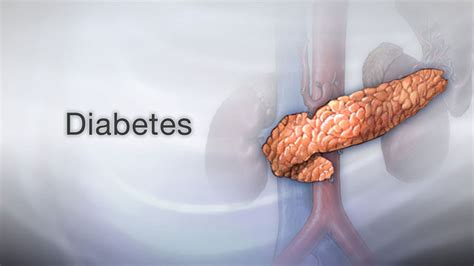 HIE Multimedia - Diabetes and nerve damage