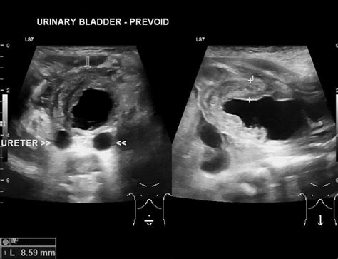 Posterior Urethral Valves Ultrasound