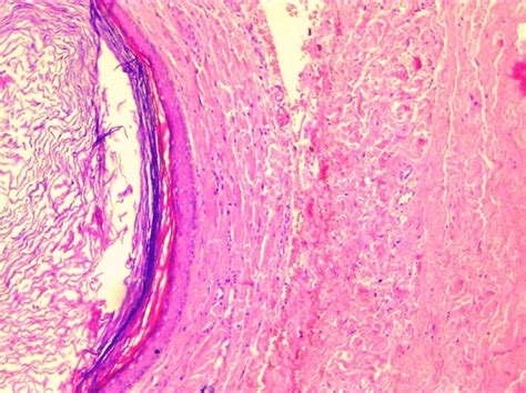 Cyst Wall Is Composed Of Keratinized Stratified Squamous Epithelium
