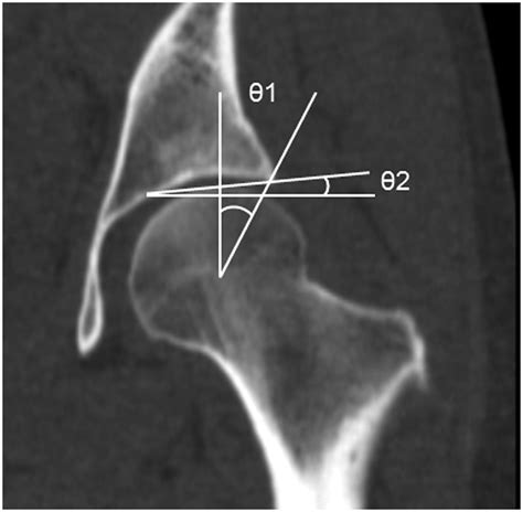 Prevalence Of Pincer Cam And Combined Deformities In Japanese Hip