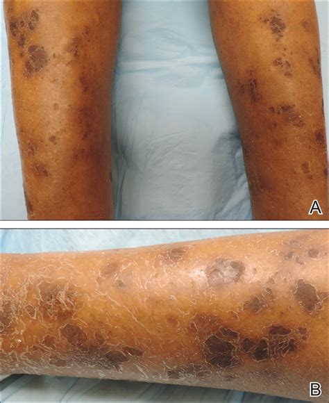 Ichthyosiform Sarcoidosis And Systemic Involvement Mdedge Dermatology