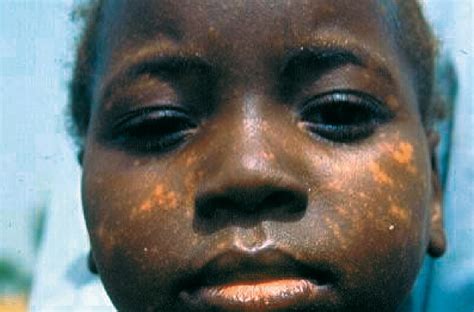 Post Kala Azar Dermal Leishmaniasis The Lancet Infectious Diseases