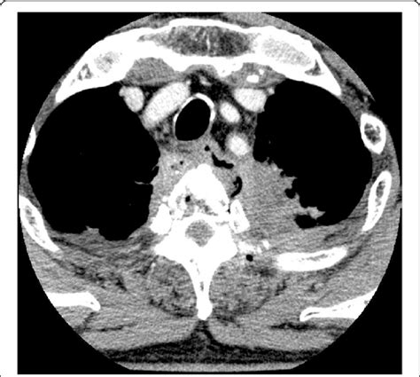 Contrast Enhanced Chest Ct Scan Suggested The Perforation Of The