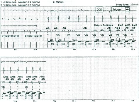 Atrial fibrillation induced by appropriate ventricular antitachycardia