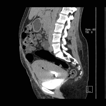 Vesico Uterine Fistula Radiology Case Radiopaedia Org