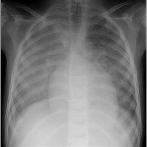 Chest X Ray Showing Pulmonary Infiltrates And Cardiomegaly Download
