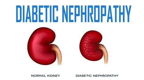 Diabetic Nephropathy Pathology Causes Symptoms Diagnosis