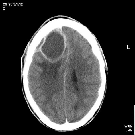 Ct Scan Without Contrast Showing Multiple Intracerebral Abscesses With