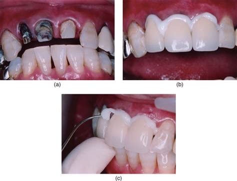 8: Dental cements | Pocket Dentistry