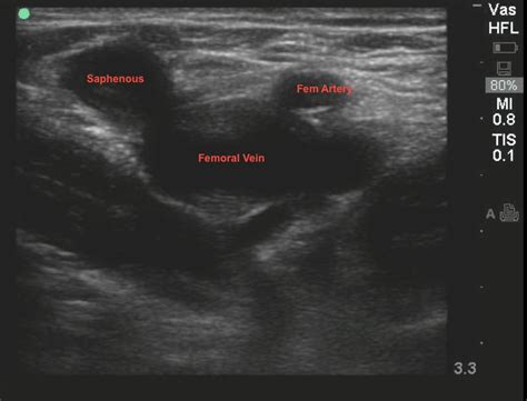 Vascular Ultrasound Of Legs