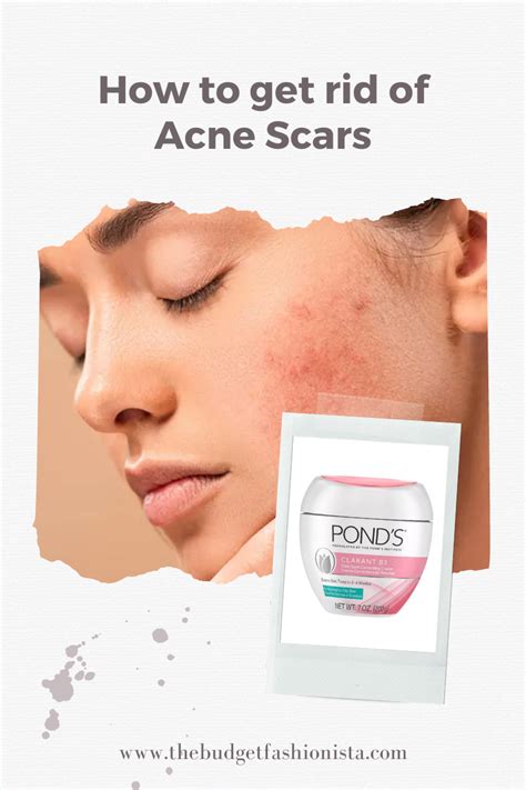 How To Get Rid Of Acne Scars 8 Ways The Complete Guide Budget