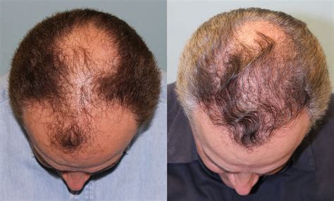 Hair Transplant Before And After 4 Jesse E Smith Md Facs Ft Worthcolleyville Facial