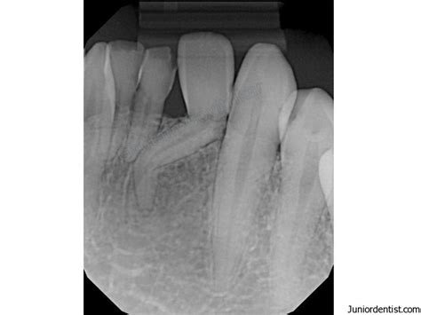 Dilaceration Of Tooth