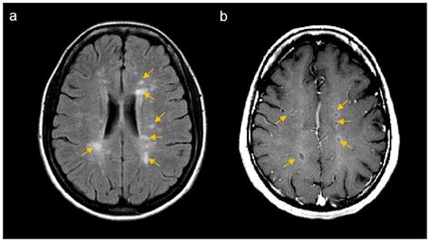 Ijms Free Full Text What Do Effective Treatments For Multiple