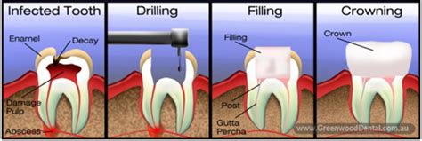 Root canal treatment is performed under local anesthesia. Root Canal