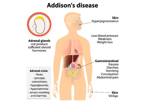 Addison S Disease W3schools