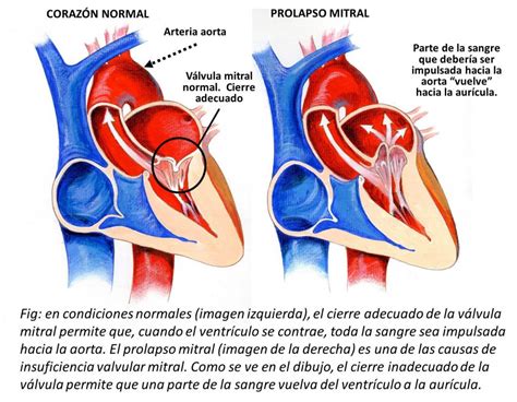 Insuficiencia De La Válvula Mitral Cardiosaudeferrol