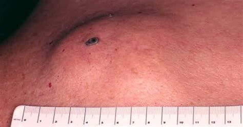 Epidermoid Cysts Represent The Most Common Cutaneous Cysts While They