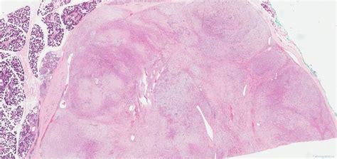 Myoepithelioma Of The Salivary Glands Atlas Of Pathology