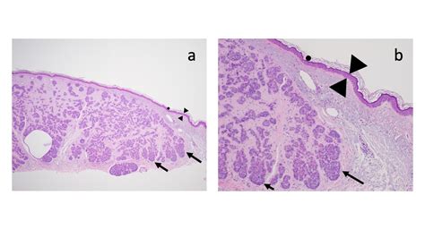 Cureus Basal Cell Carcinoma Associated With Secondary Localized