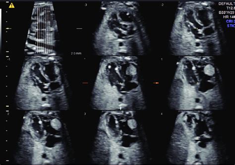 Fetal Echocardiography Spatiotemporal Image Correlation Tomographic