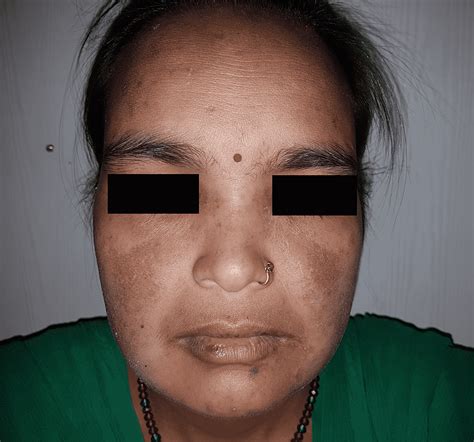 Cureus Systemic Lupus Erythematosus In India A Clinico Serological