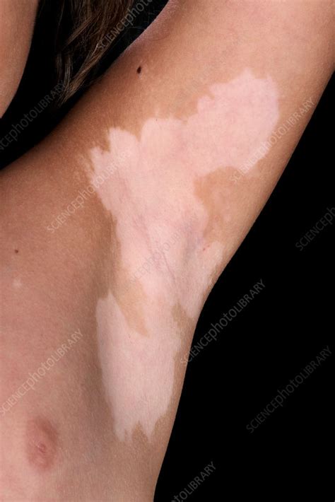Vitiligo Skin Condition Stock Image C0382273 Science Photo Library