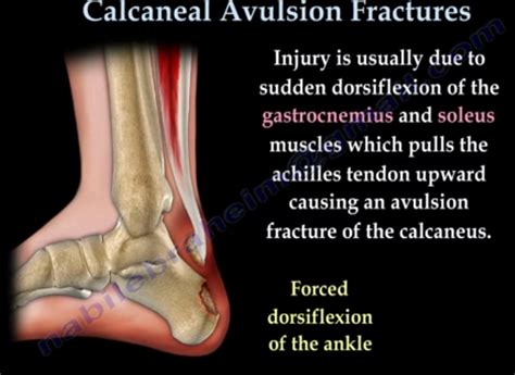 Calcaneal Avulsion Fractures —