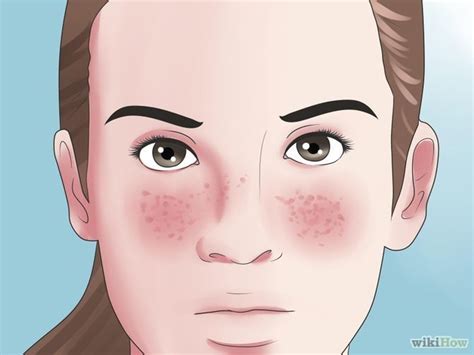 How To Tell Eczema From Butterfly Rash 6 Steps With Pictures Lupus