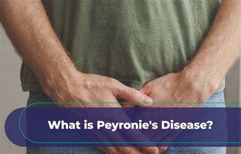 What Is Peyronie S Disease It S Causes Symptoms Treatment