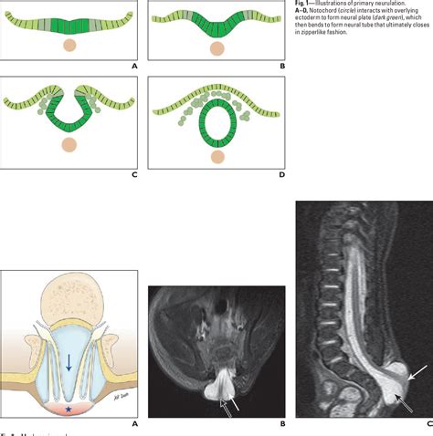 Figure 1 From Congenital Spine And Spinal Cord Malformations Pictorial Review Semantic Scholar