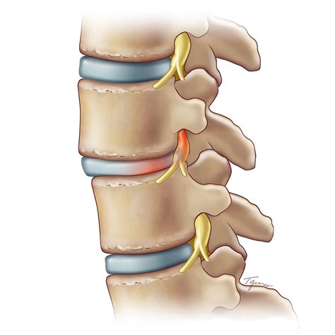 Sciatica is usually caused by a lower back disk injury, usually a slipped disk pressing on the nerve; Spondylolisthesis | Weill Cornell Brain and Spine Center
