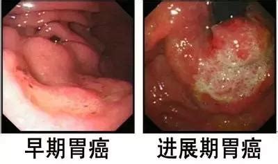 胃癌（stomach cancer、gastric cancer）是發生在胃部黏膜的癌症。 早期的症狀包括胃灼熱，上腹疼痛，惡心及食慾不振。 症狀與消化性潰瘍類似，是導致延誤就醫與高死亡率的原因，但其痛感與潰瘍還是有些許差異，胃潰瘍. 發現胃癌後，要不要手術治療？ - 每日頭條